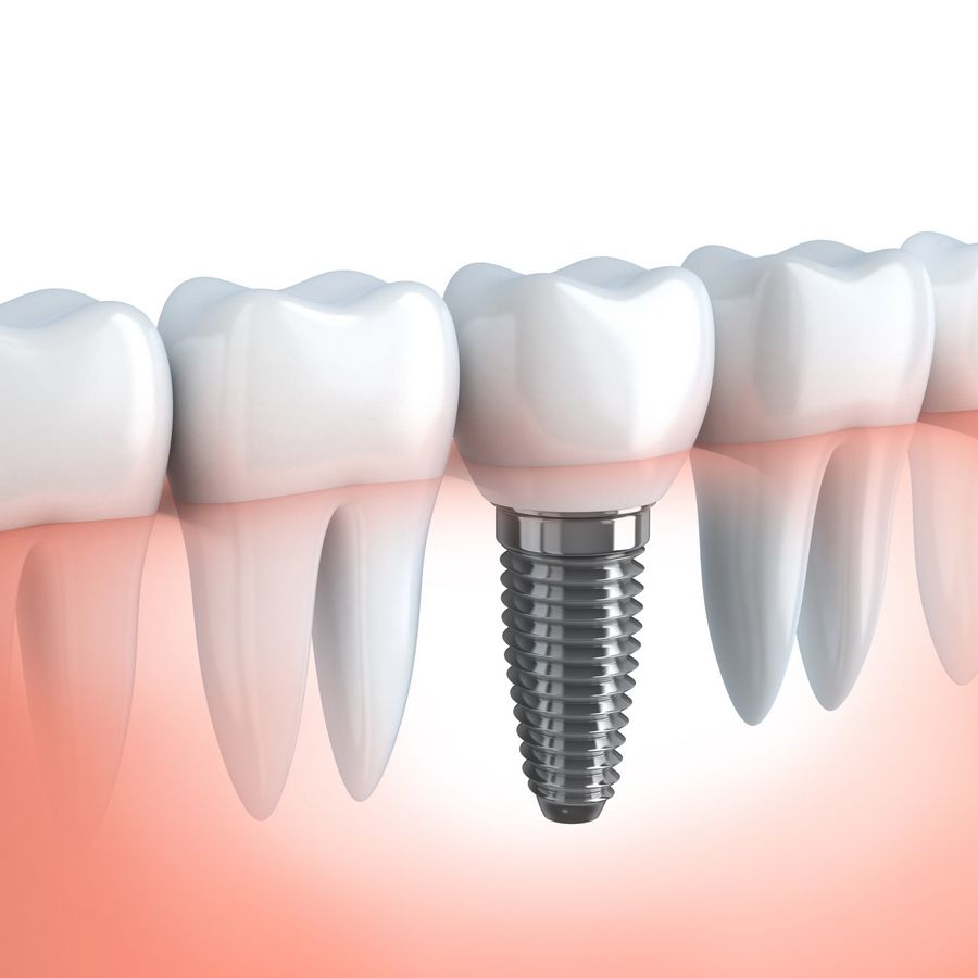 implante dentario e suas tecnologias 2
