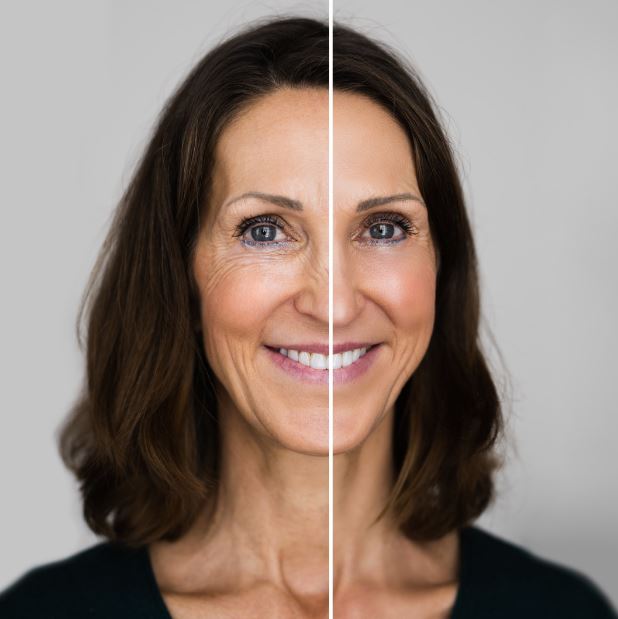 Uma das maiores demandas dos pacientes que buscam tratamentos estéticos se resume em disfarçar os sinais de envelhecimento da pele, especialmente rugas, linhas de expressão e flacidez facial.